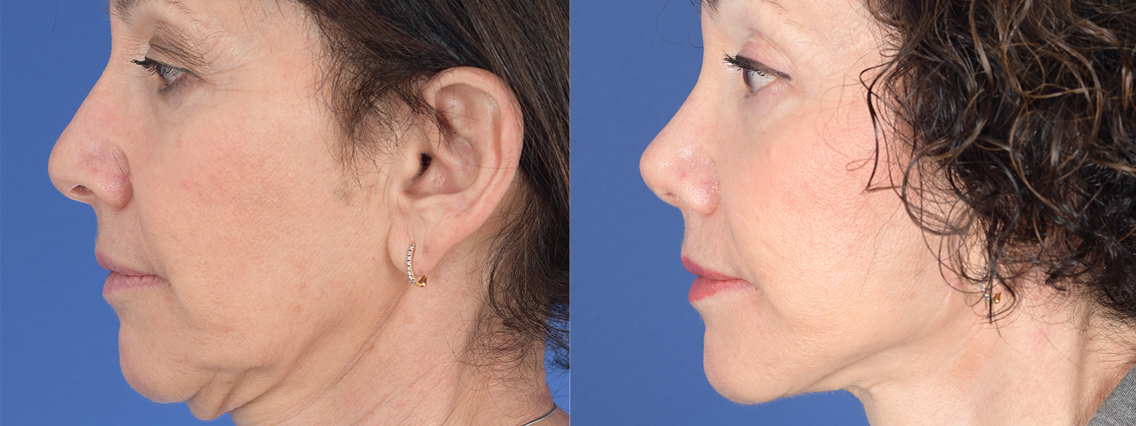Blepharoplasty Before and After | Weber Facial Plastic Surgery