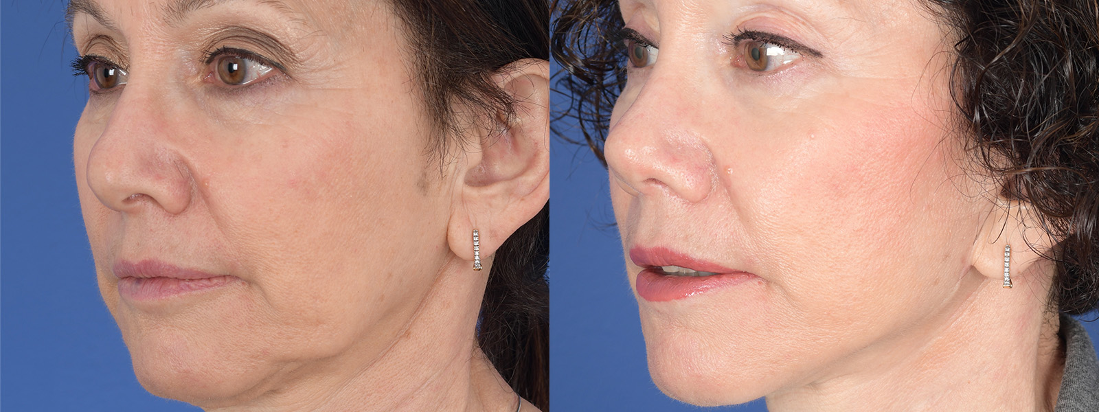 Blepharoplasty Before and After | Weber Facial Plastic Surgery