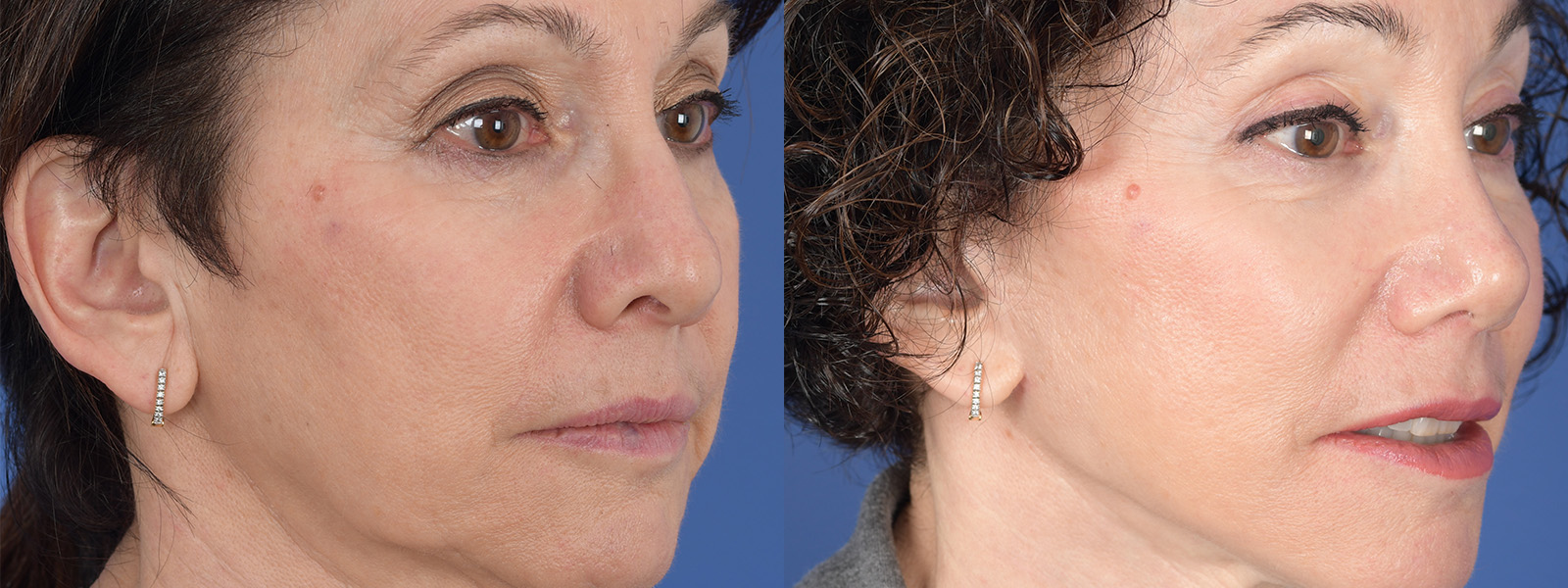 Blepharoplasty Before and After | Weber Facial Plastic Surgery