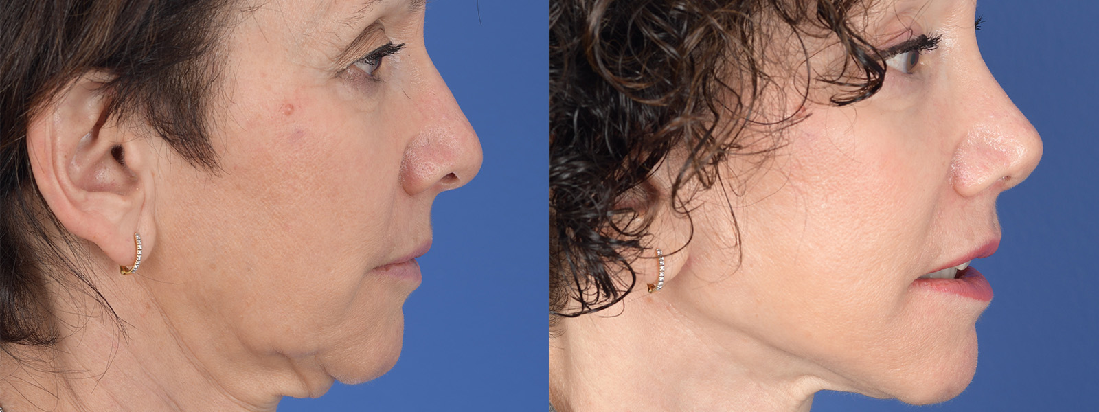 Blepharoplasty Before and After | Weber Facial Plastic Surgery