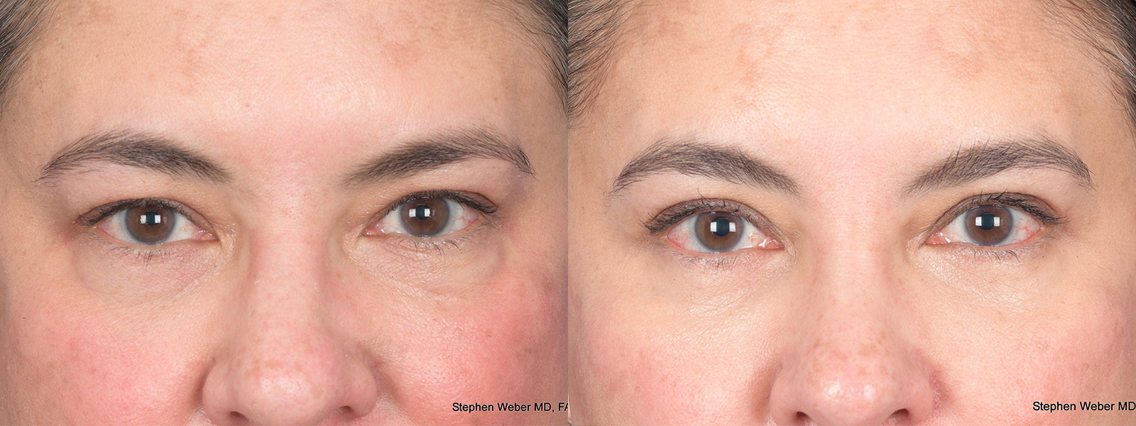 Blepharoplasty Before and After | Weber Facial Plastic Surgery