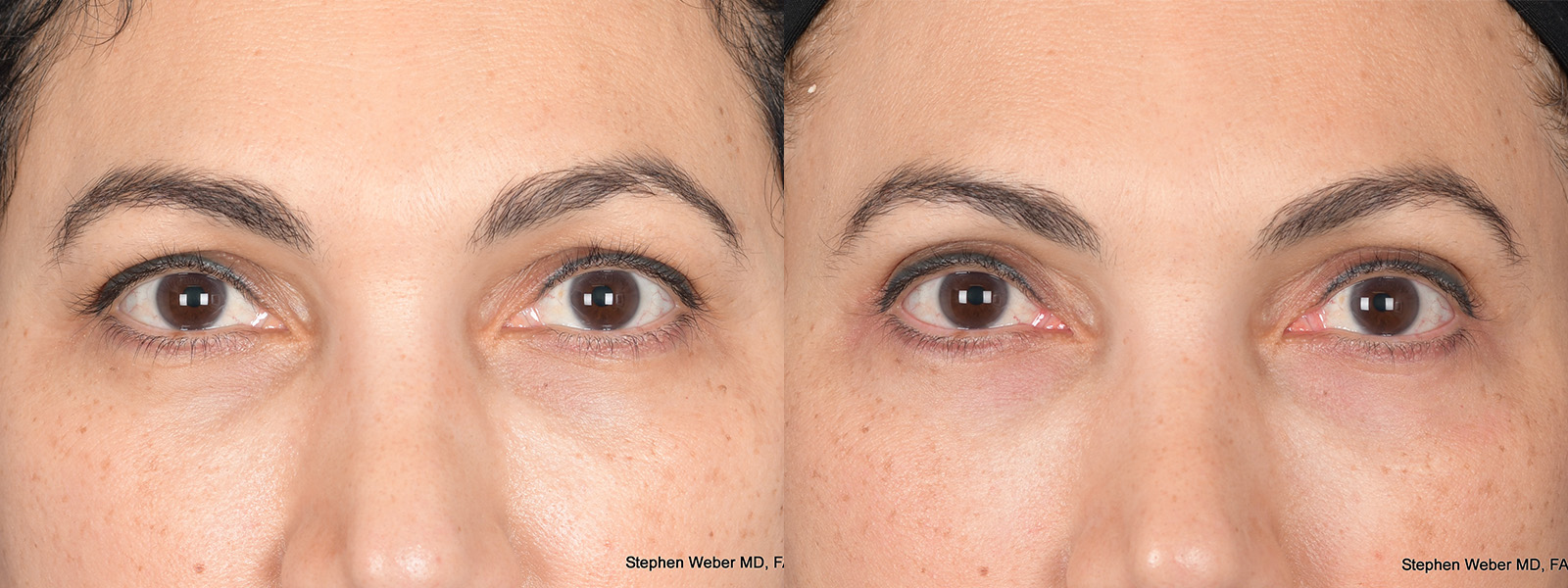 Blepharoplasty Before and After | Weber Facial Plastic Surgery