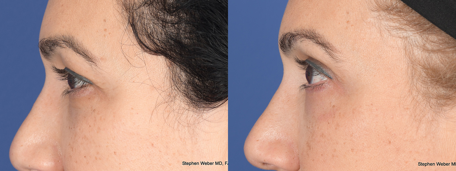 Blepharoplasty Before and After | Weber Facial Plastic Surgery
