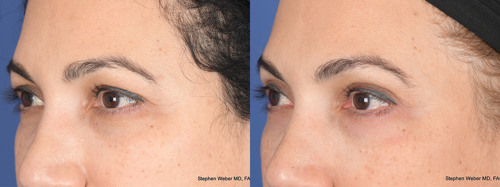 Blepharoplasty Before and After | Weber Facial Plastic Surgery