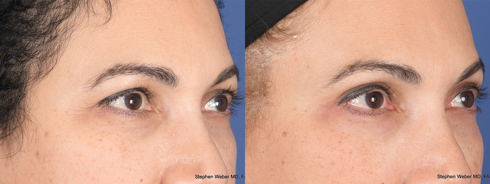 Blepharoplasty Before and After | Weber Facial Plastic Surgery
