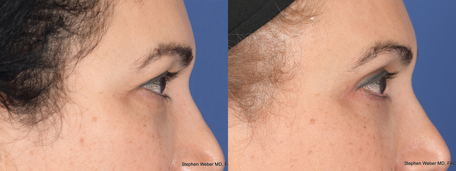 Blepharoplasty Before and After | Weber Facial Plastic Surgery