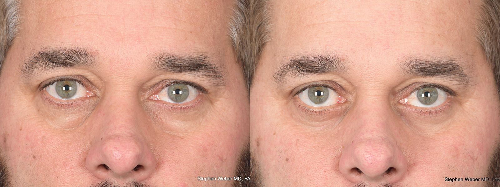 Blepharoplasty Before and After | Weber Facial Plastic Surgery