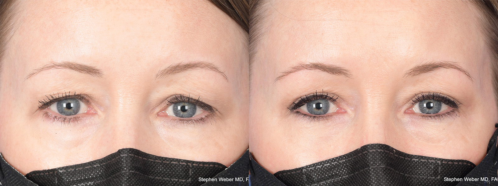 Blepharoplasty Before and After | Weber Facial Plastic Surgery