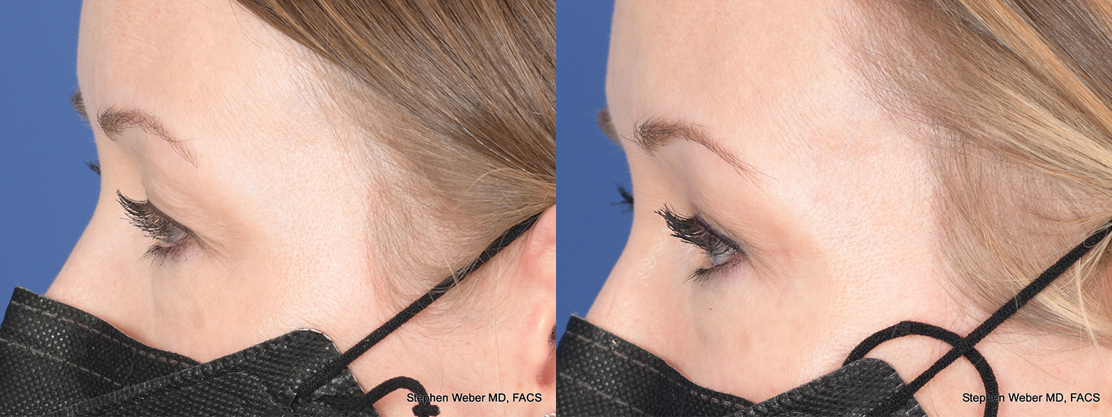 Blepharoplasty Before and After | Weber Facial Plastic Surgery