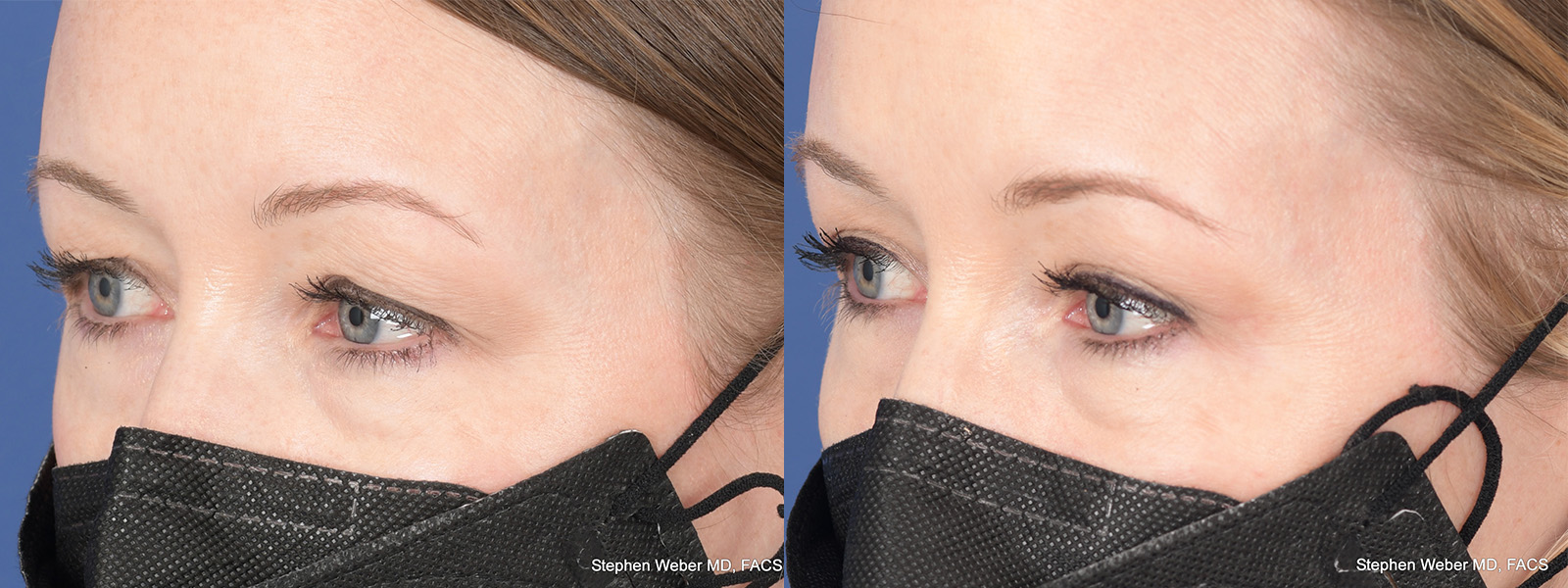Blepharoplasty Before and After | Weber Facial Plastic Surgery