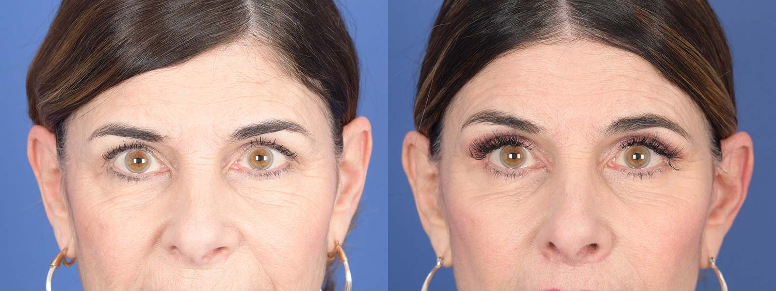 Blepharoplasty Before and After | Weber Facial Plastic Surgery
