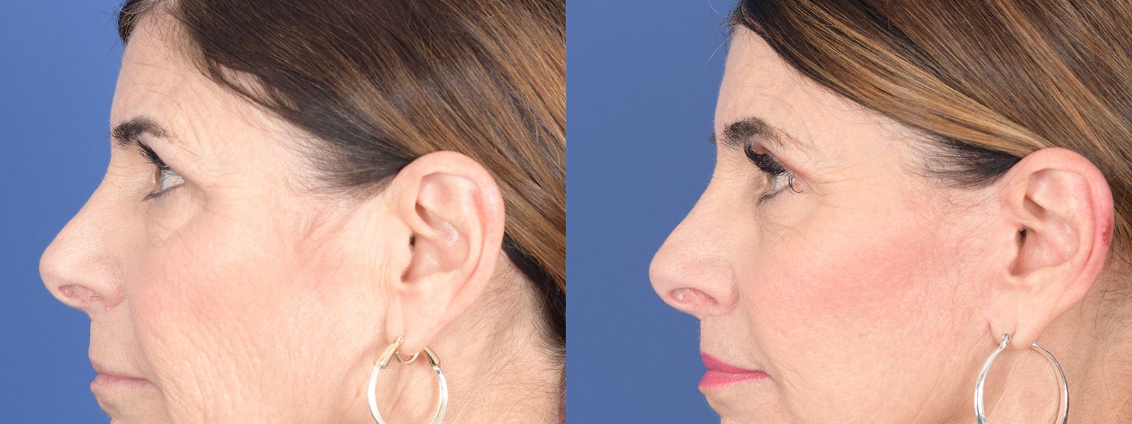 Blepharoplasty Before and After | Weber Facial Plastic Surgery