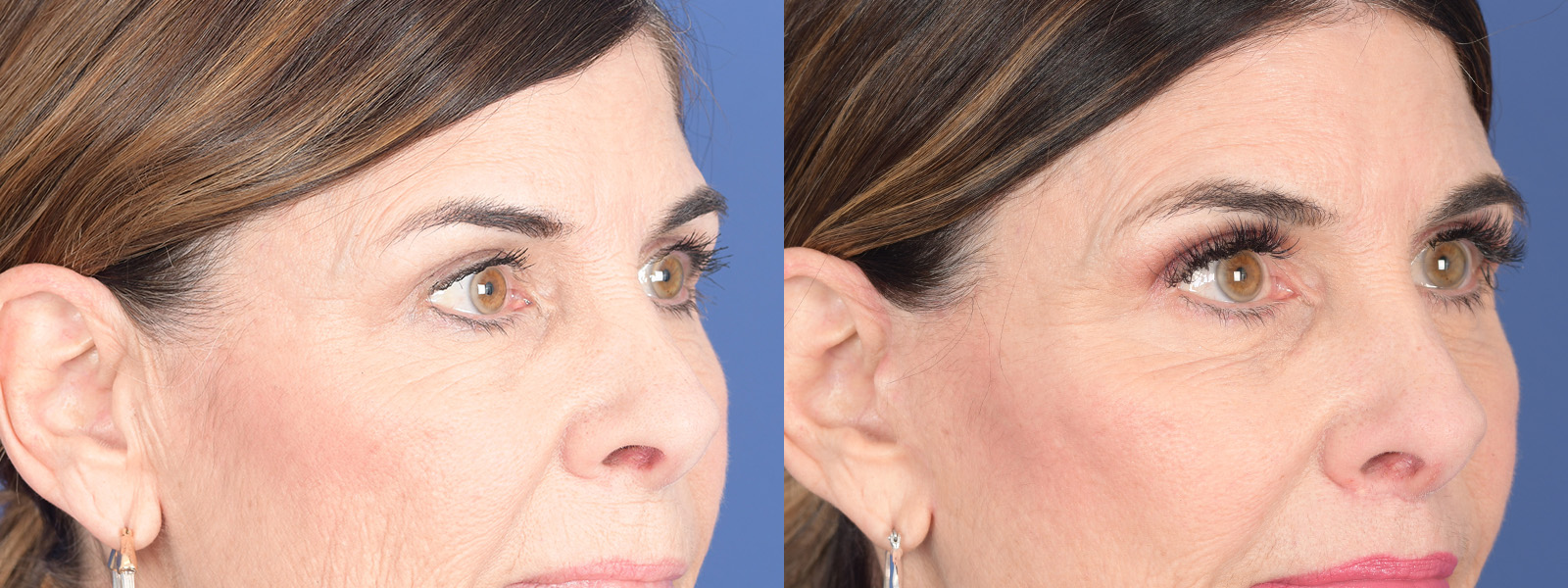 Blepharoplasty Before and After | Weber Facial Plastic Surgery