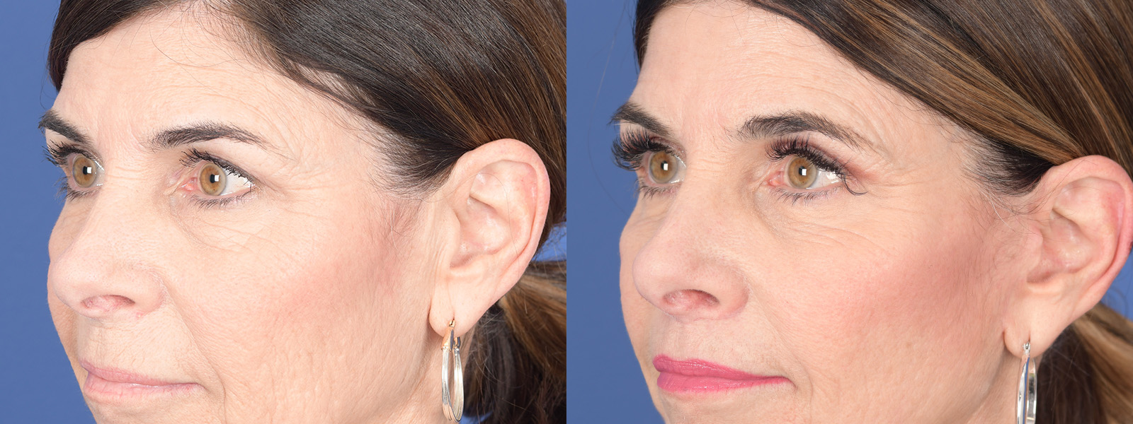 Blepharoplasty Before and After | Weber Facial Plastic Surgery