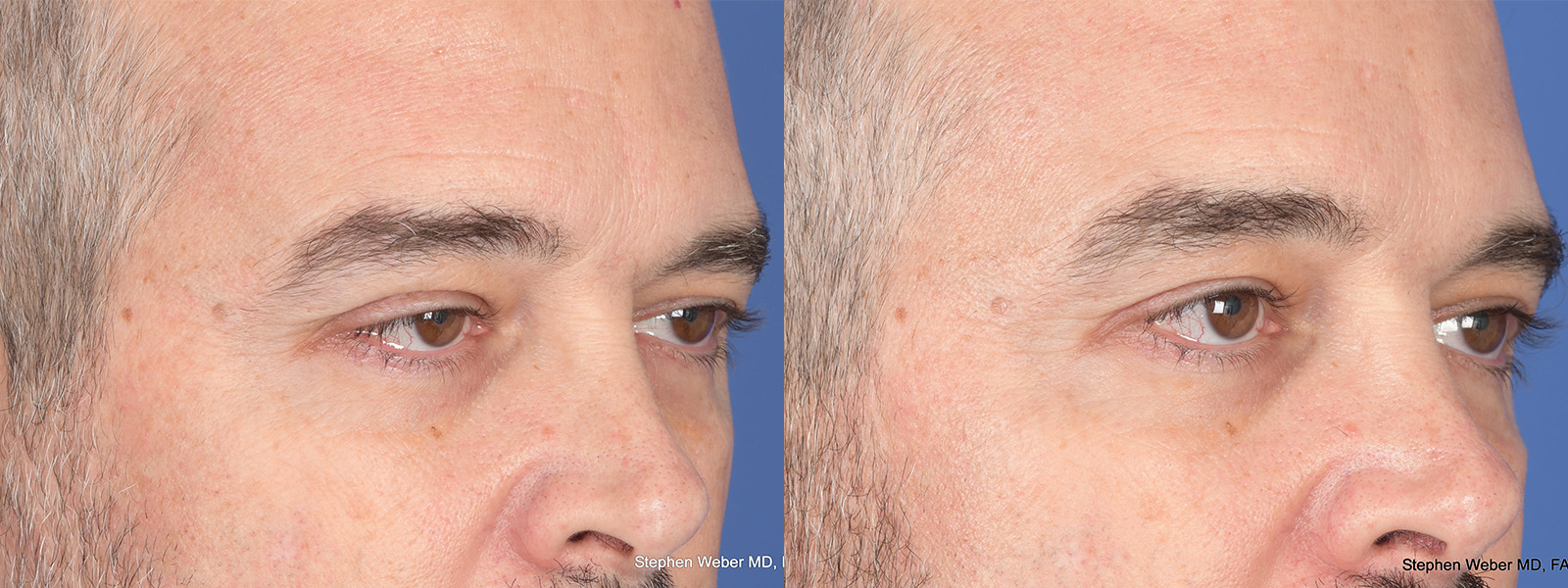 Blepharoplasty Before and After | Weber Facial Plastic Surgery