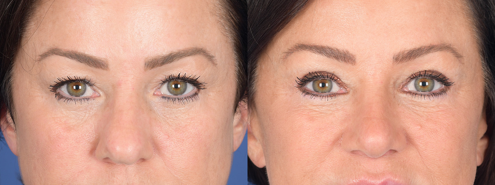 Blepharoplasty Before and After | Weber Facial Plastic Surgery