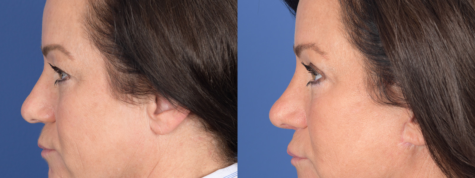 Blepharoplasty Before and After | Weber Facial Plastic Surgery