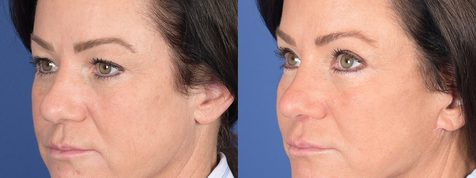 Blepharoplasty Before and After | Weber Facial Plastic Surgery