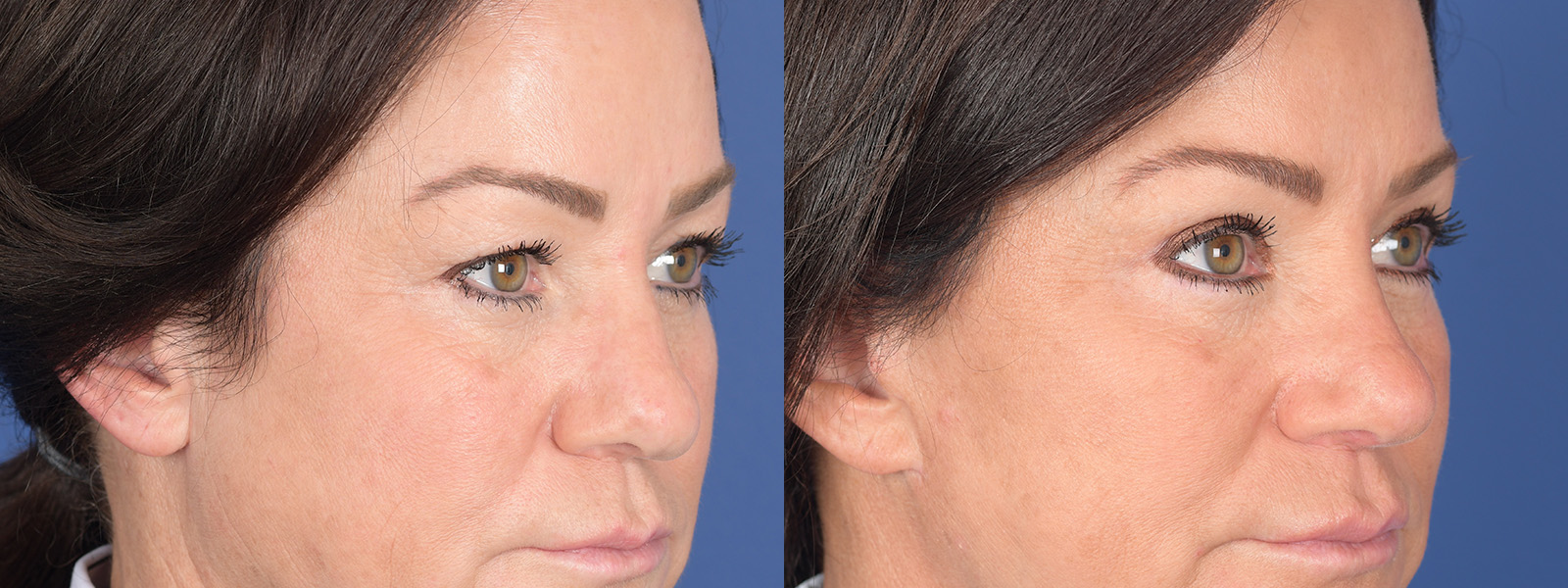 Blepharoplasty Before and After | Weber Facial Plastic Surgery