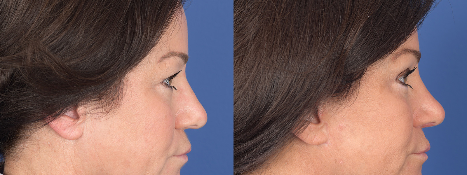 Blepharoplasty Before and After | Weber Facial Plastic Surgery