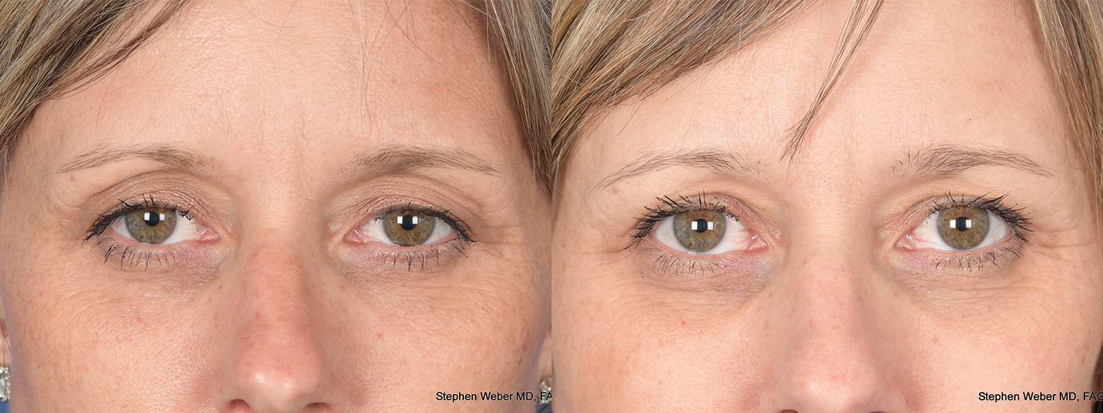 Blepharoplasty Before and After | Weber Facial Plastic Surgery