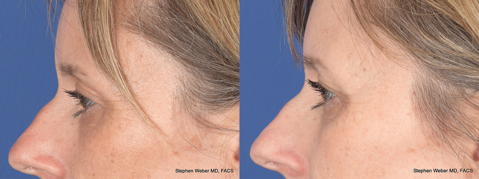 Blepharoplasty Before and After | Weber Facial Plastic Surgery