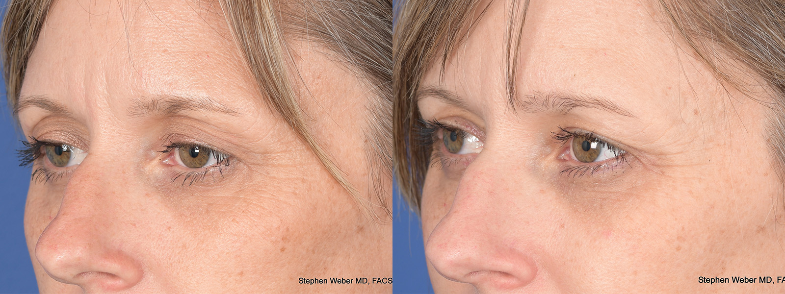 Blepharoplasty Before and After | Weber Facial Plastic Surgery