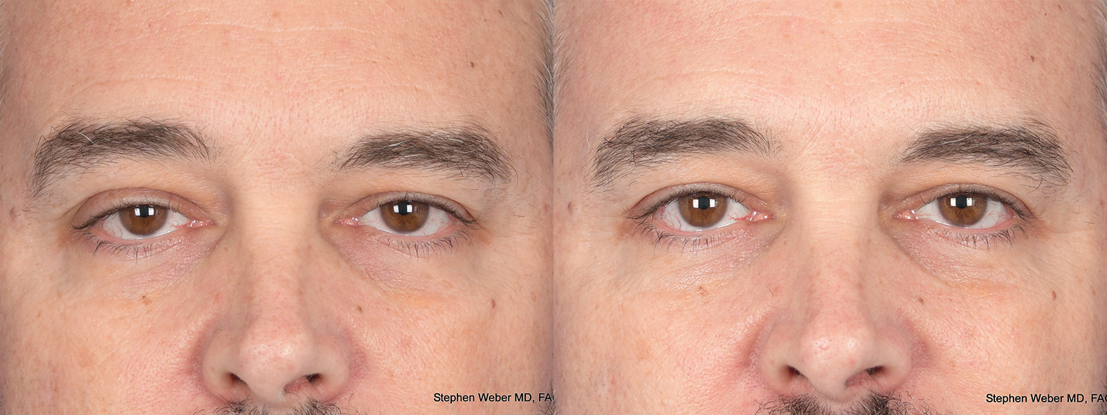 Blepharoplasty Before and After | Weber Facial Plastic Surgery