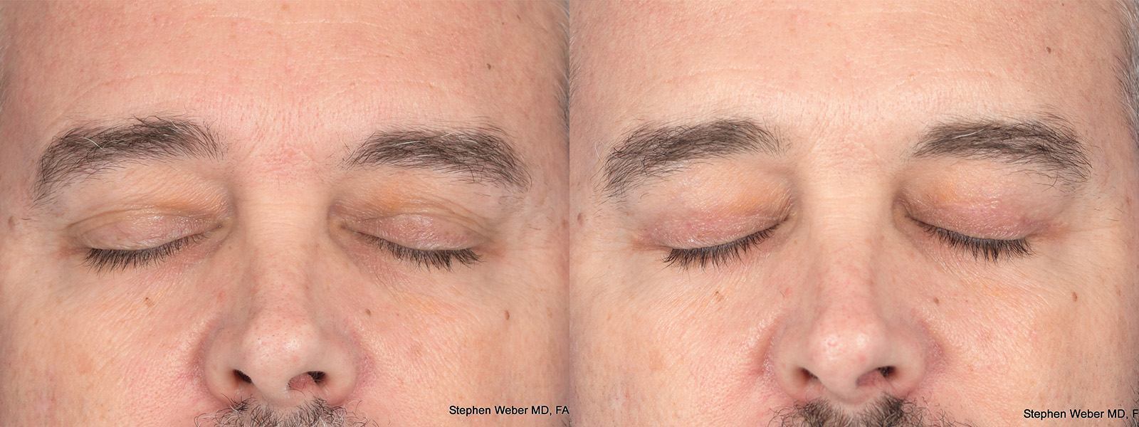 Blepharoplasty Before and After | Weber Facial Plastic Surgery
