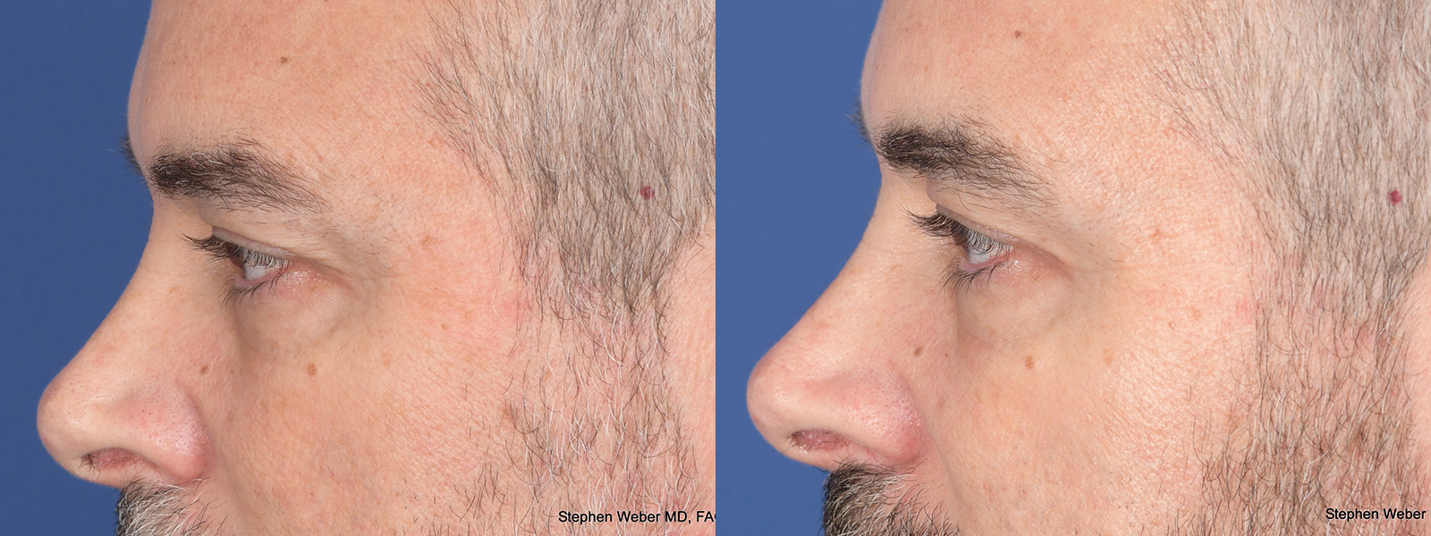 Blepharoplasty Before and After | Weber Facial Plastic Surgery