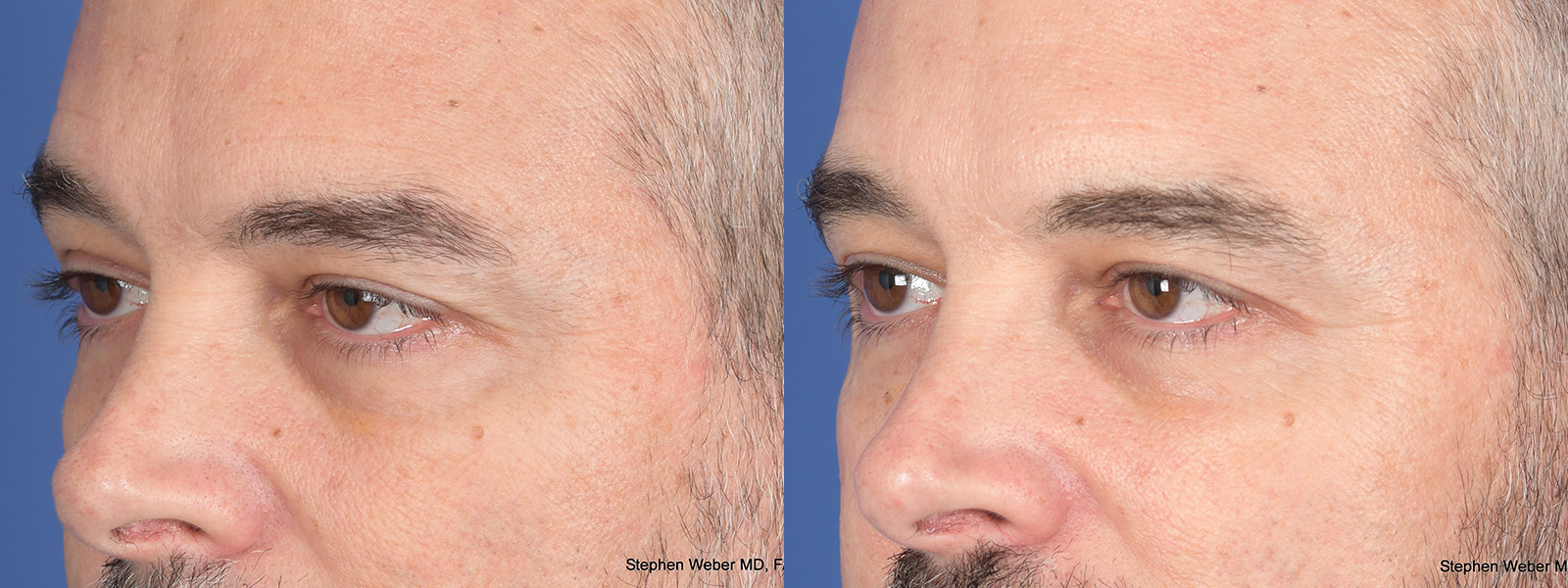 Blepharoplasty Before and After | Weber Facial Plastic Surgery