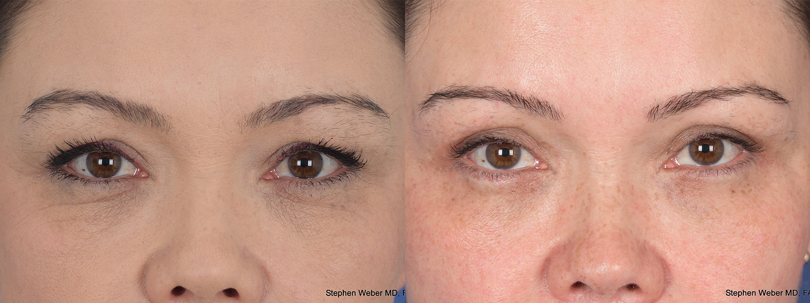 Blepharoplasty Before and After | Weber Facial Plastic Surgery