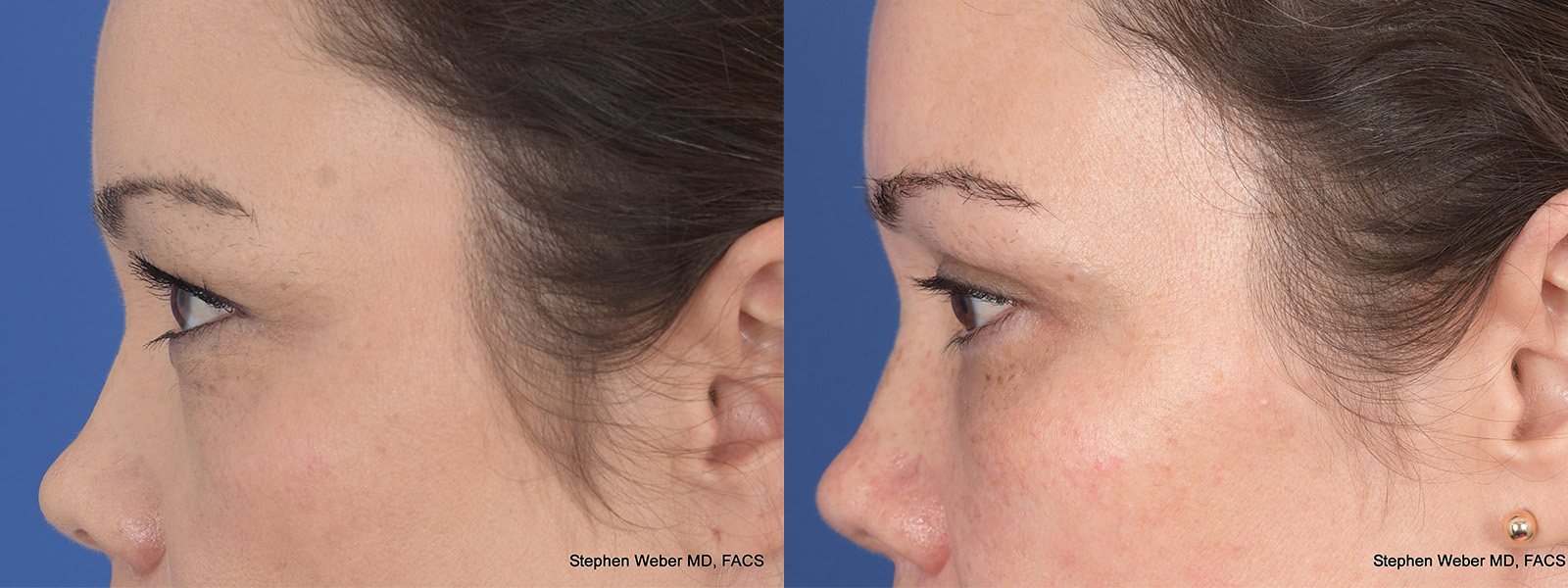 Blepharoplasty Before and After | Weber Facial Plastic Surgery