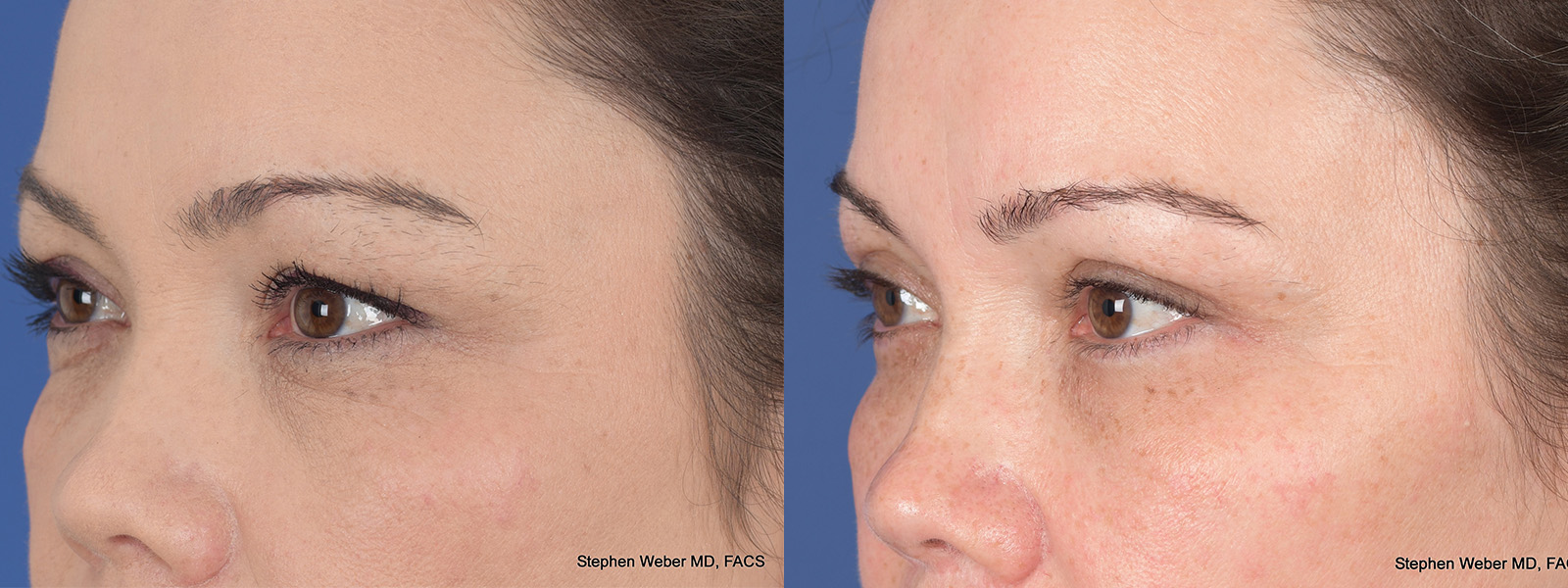 Blepharoplasty Before and After | Weber Facial Plastic Surgery