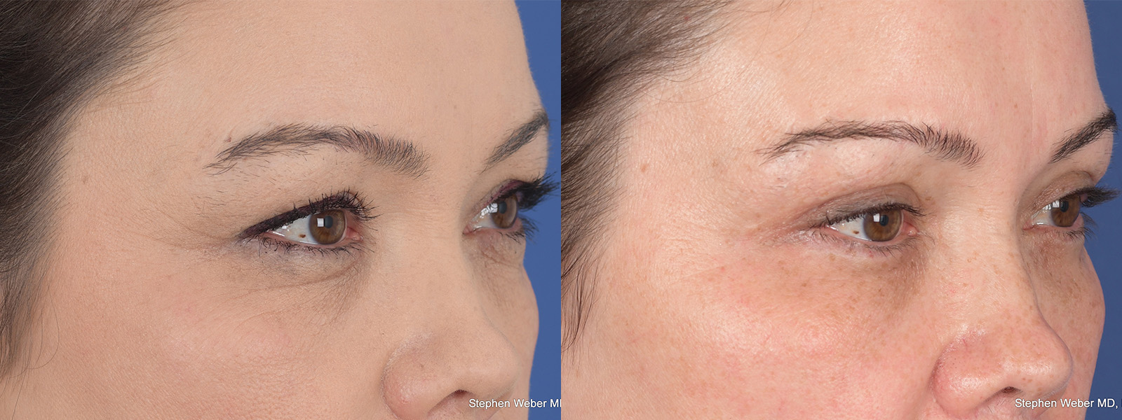 Blepharoplasty Before and After | Weber Facial Plastic Surgery