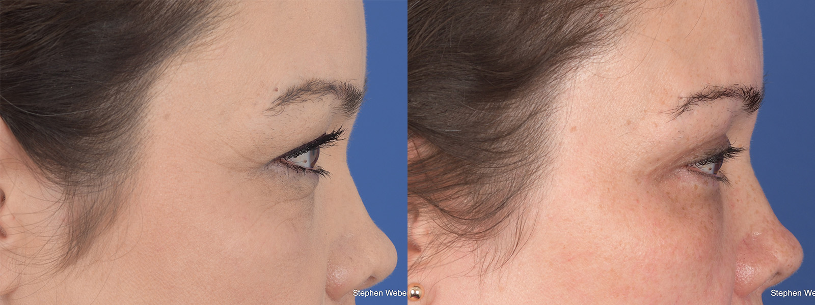 Blepharoplasty Before and After | Weber Facial Plastic Surgery