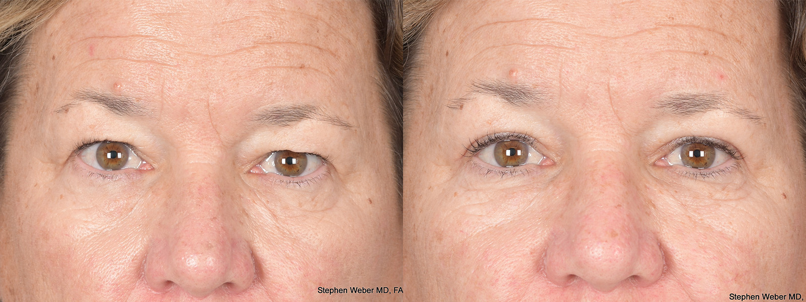 Blepharoplasty Before and After | Weber Facial Plastic Surgery