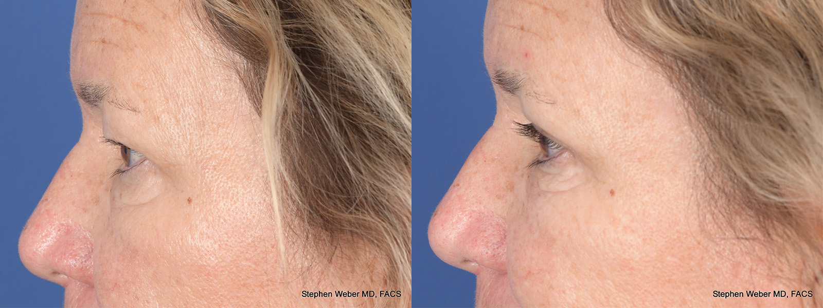 Blepharoplasty Before and After | Weber Facial Plastic Surgery