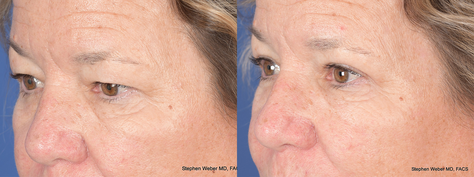 Blepharoplasty Before and After | Weber Facial Plastic Surgery