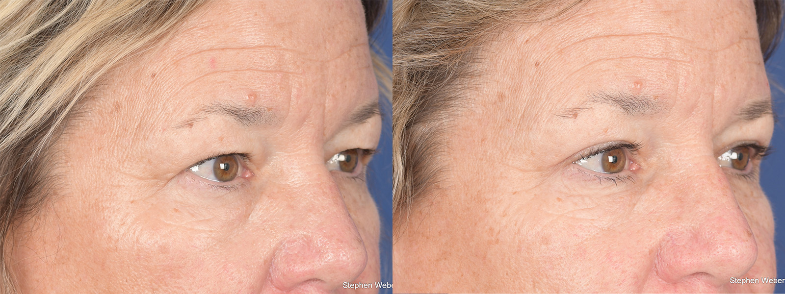 Blepharoplasty Before and After | Weber Facial Plastic Surgery