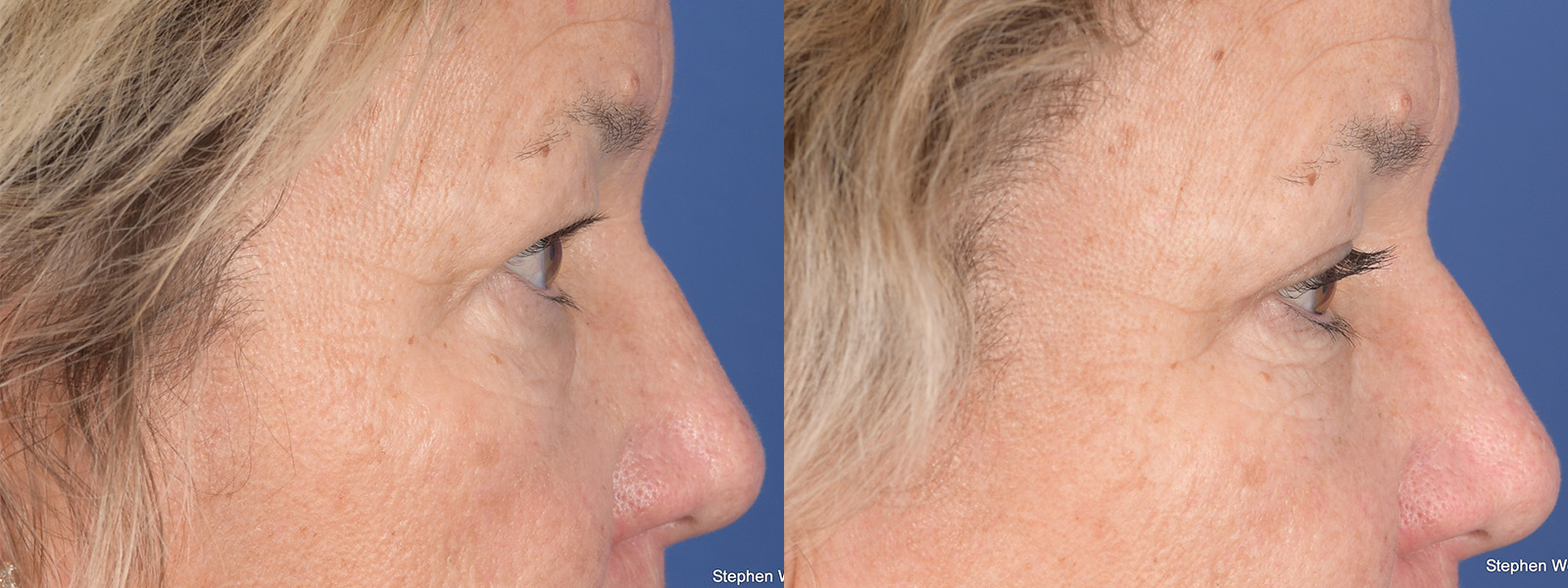 Blepharoplasty Before and After | Weber Facial Plastic Surgery