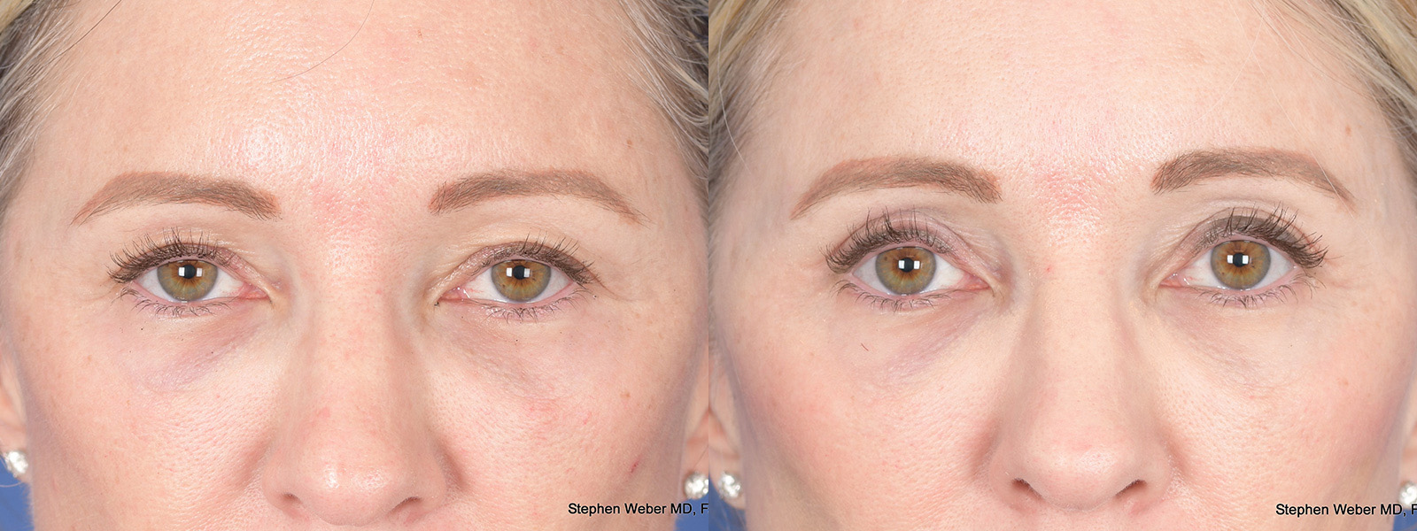 Blepharoplasty Before and After | Weber Facial Plastic Surgery