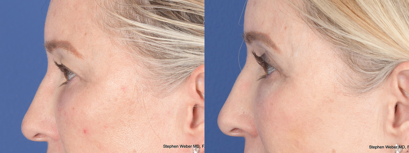 Blepharoplasty Before and After | Weber Facial Plastic Surgery