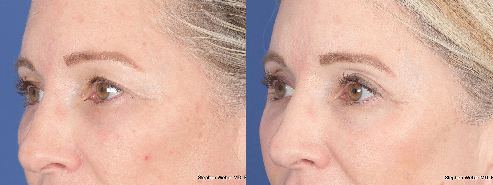 Blepharoplasty Before and After | Weber Facial Plastic Surgery