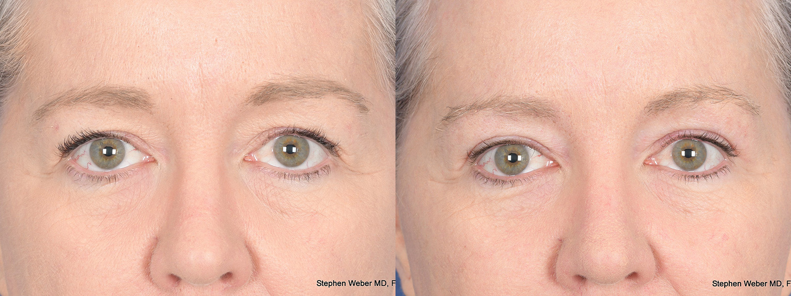 Blepharoplasty Before and After | Weber Facial Plastic Surgery