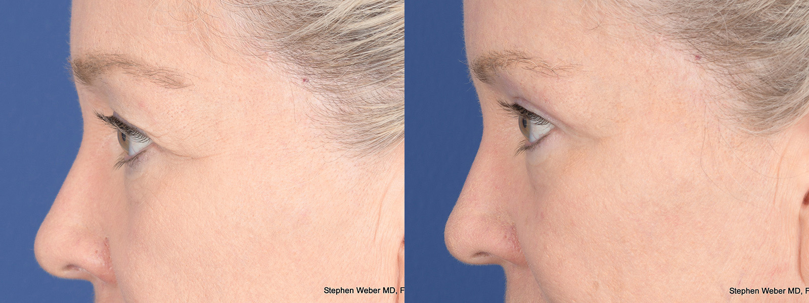Blepharoplasty Before and After | Weber Facial Plastic Surgery