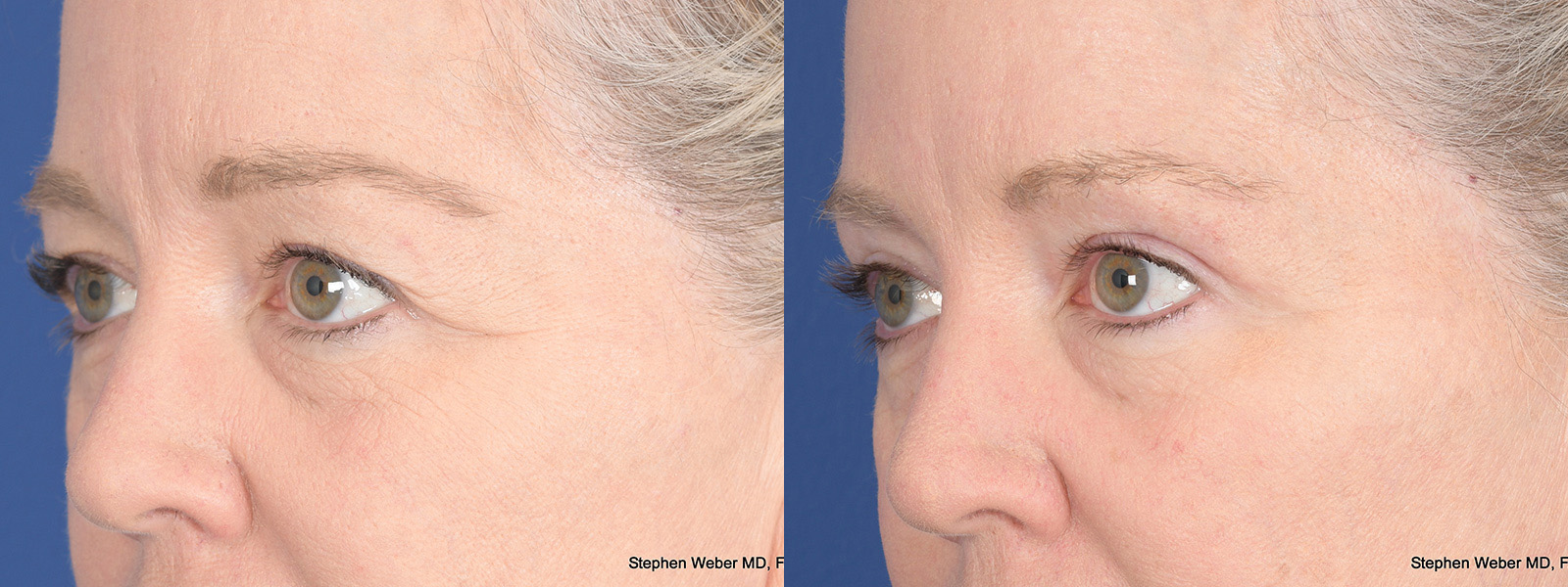 Blepharoplasty Before and After | Weber Facial Plastic Surgery