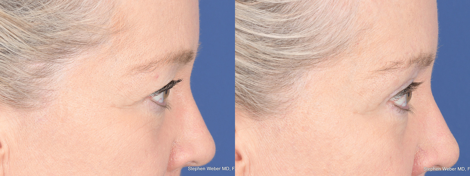 Blepharoplasty Before and After | Weber Facial Plastic Surgery