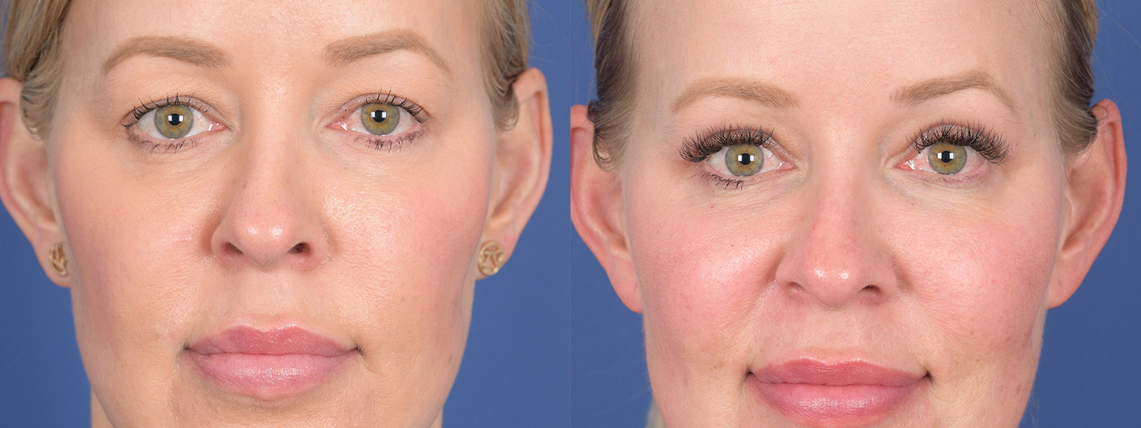 Blepharoplasty Before and After | Weber Facial Plastic Surgery