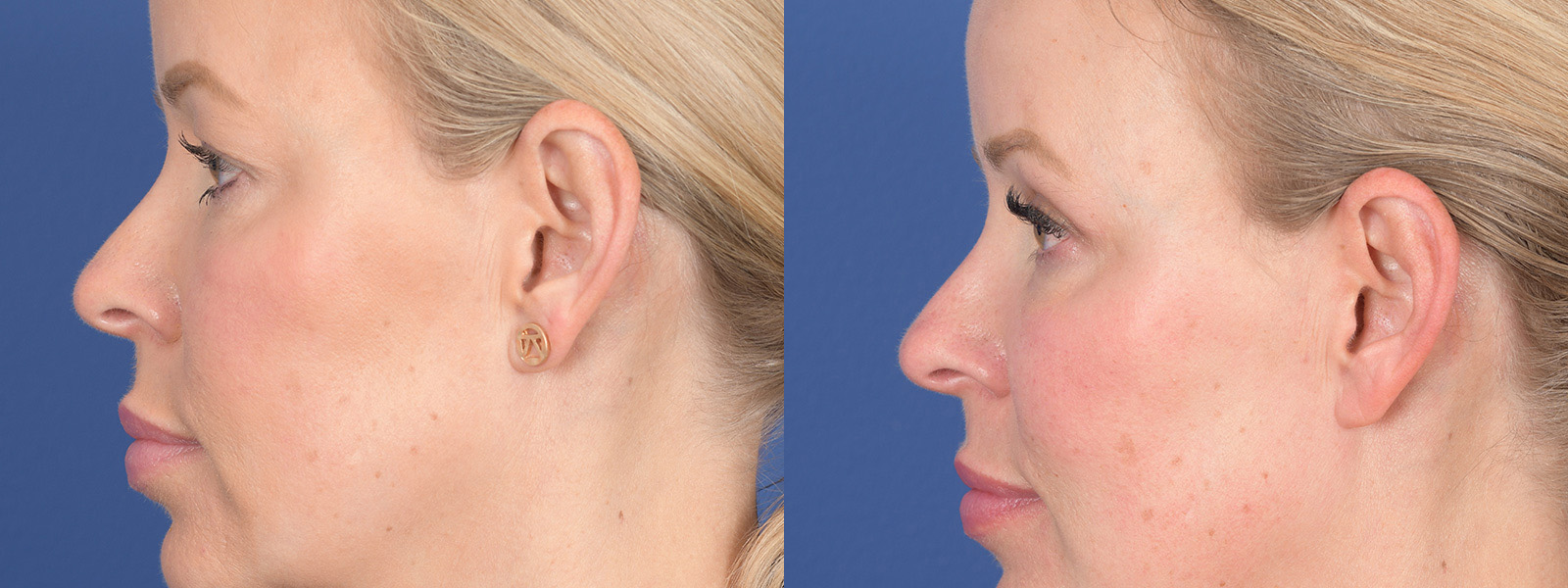 Blepharoplasty Before and After | Weber Facial Plastic Surgery